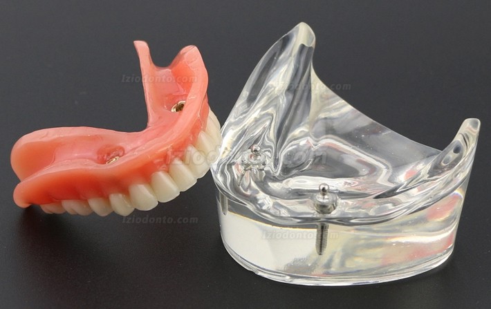 Dentes dentais modelo sobredentadura inferior com 2 implantes 6002 01